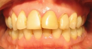 dientes-amarillos